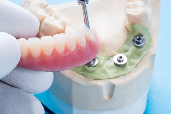 The Dangers Of Smoking With New All On   Implants