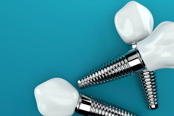 Dental Implants: Replacing A Tooth Root